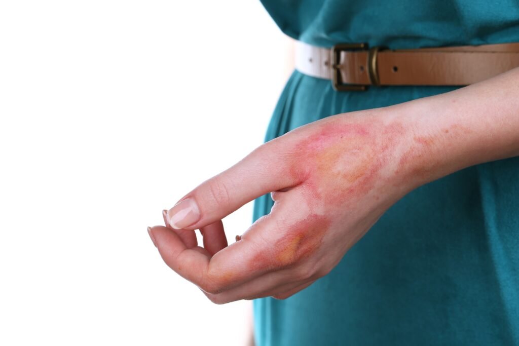 A close up shot of a burn on a woman's hand.